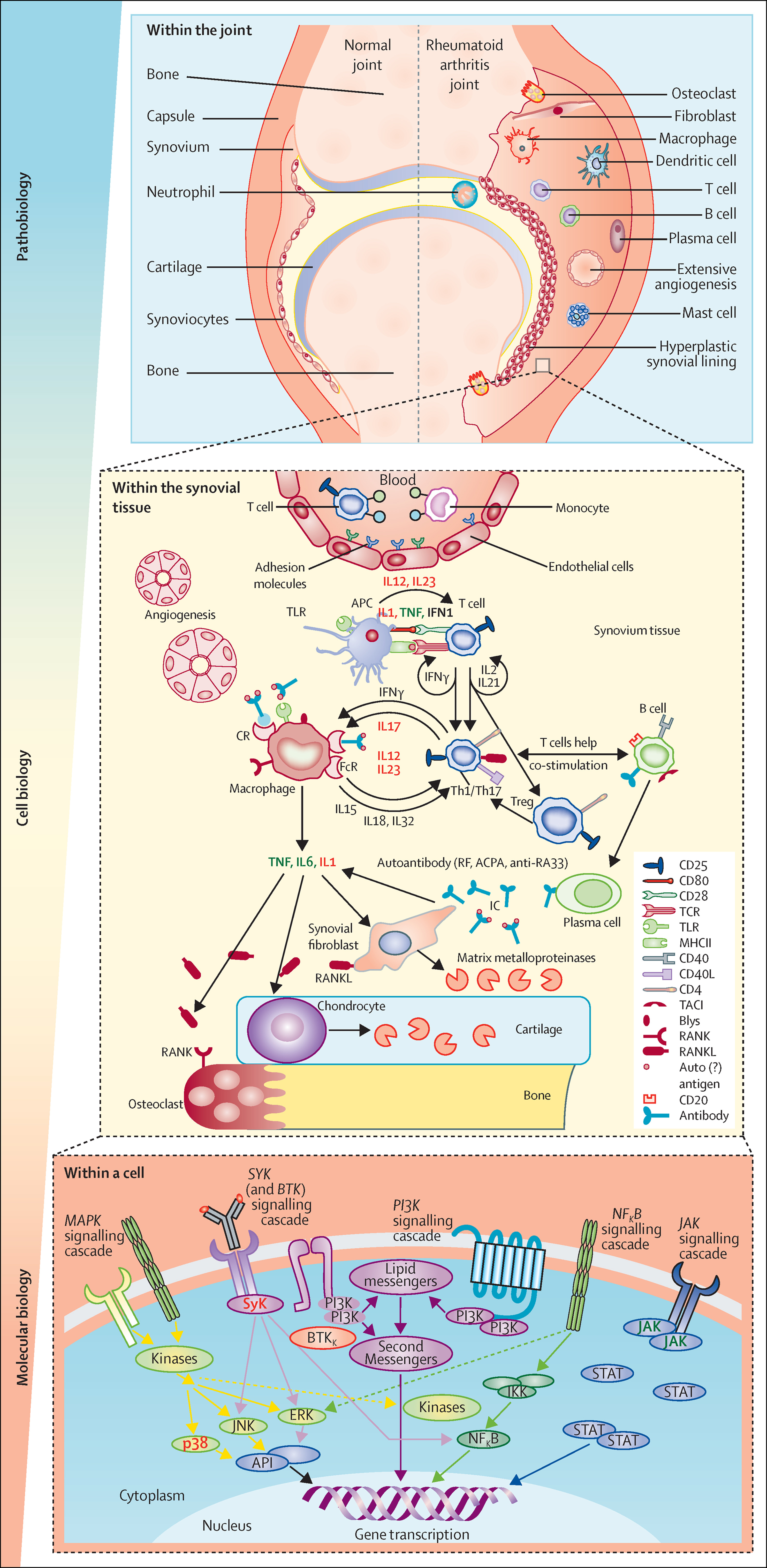 pathogenic pathway of arthritis